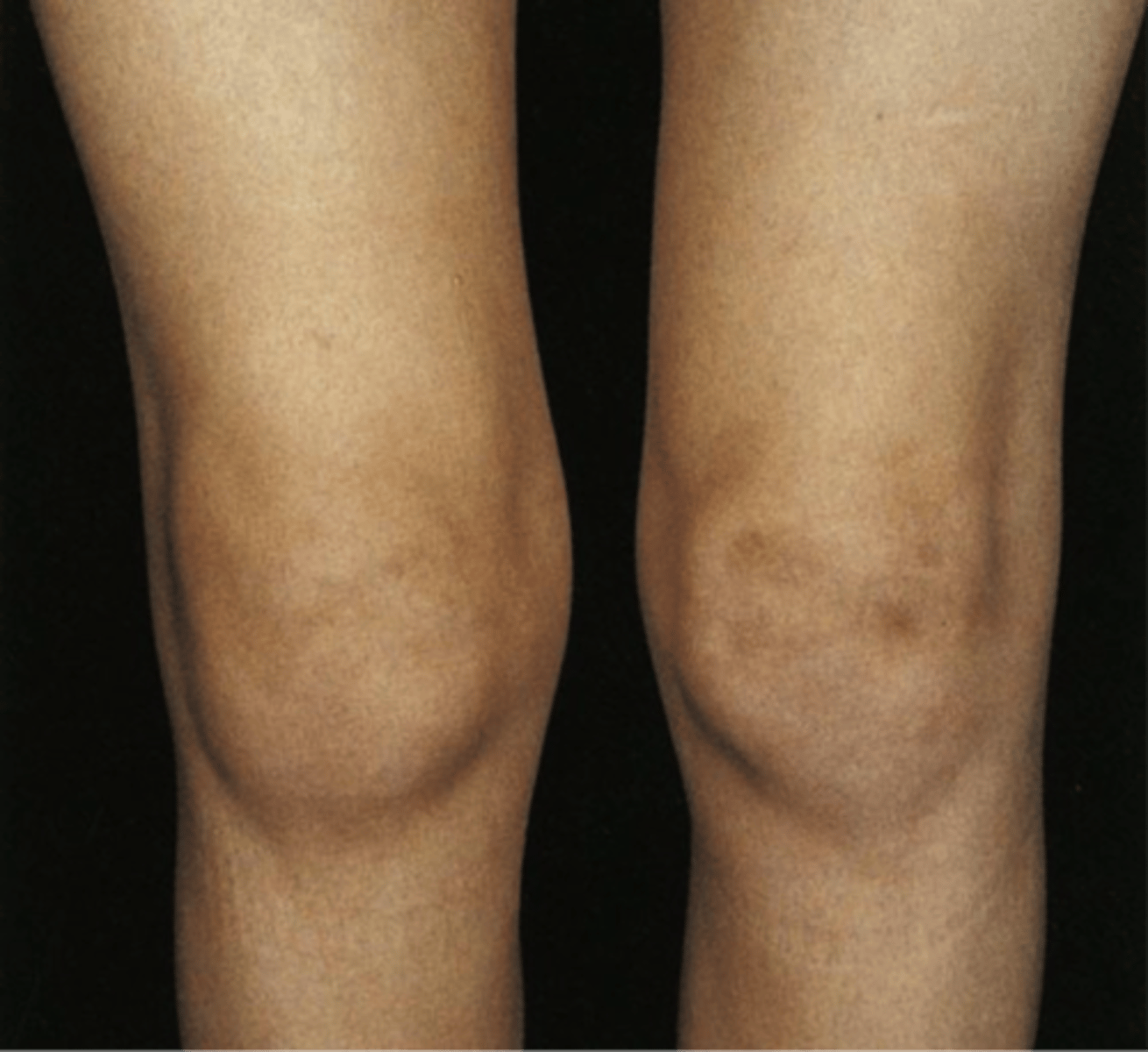 <p>Inflammation of a joint capsule, often as a complication of a sprain.</p>