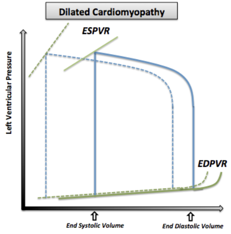 <p><strong>Increased ESV: </strong>Enlarged LV = Increased LV volume</p><p><strong>Increased EDV (Preload): </strong>Decreased contractility = Decreased SV and CO</p><p><strong>Increased Afterload:</strong> RAS activation = Increase pressure against LV</p><p><strong>Less Steep ESPVR: </strong>Decreased contractilty</p><ul><li><p>High volume changes = Low pressure changes</p></li></ul><p><strong>Increased Ventricular Filling Pressure:</strong> Decreased compliance + Increased LV size</p>