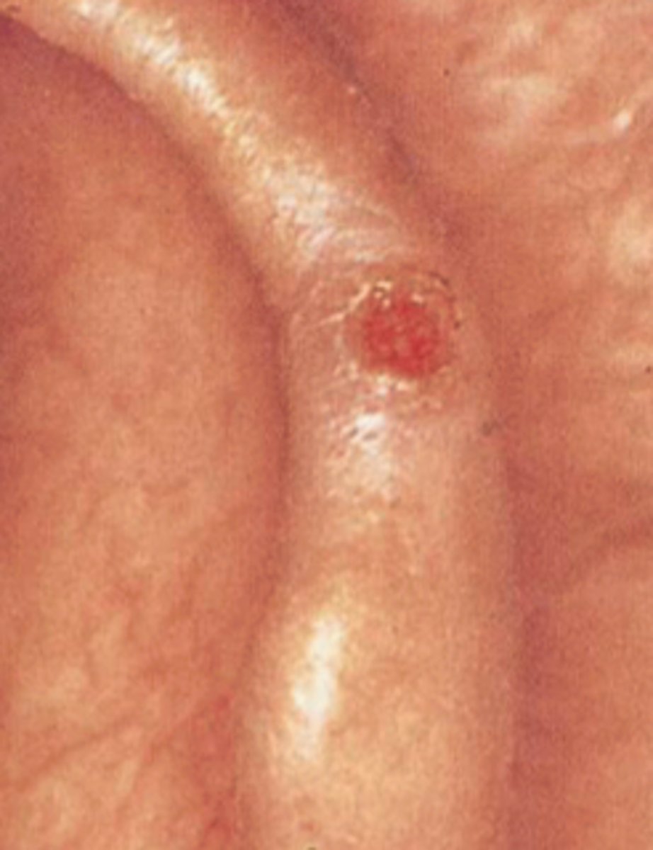 <p>Chronic inflammatory lesion</p><p>Starts as a painful, tender pustule</p><p>Helix or antihelix</p><p>May ulcerate or crust dt influence</p><p>Distinguish from carcinoma via biopsy</p>