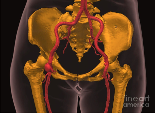 <p>What does this refer to</p><ul><li><p>Communication through a “stalk” from the artery to the “sack” </p></li><li><p>Hematoma often develops within the sack</p></li></ul><p></p>