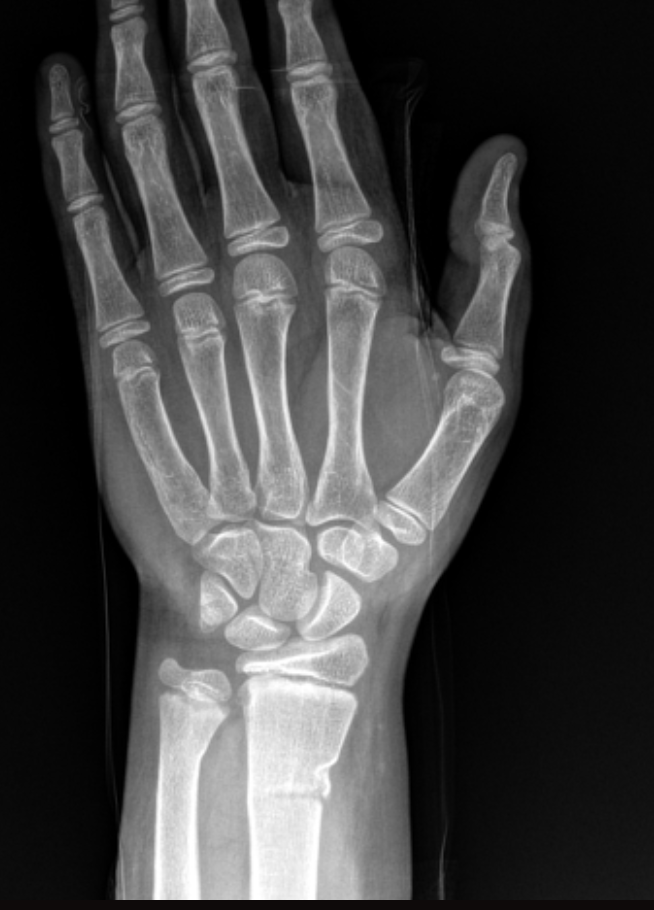 <p>A fracture that results due to a failure of cortex compression side 2-3 cm proximal to physis that is common in young children (FOOSH) and the volar cortex remains intact</p>