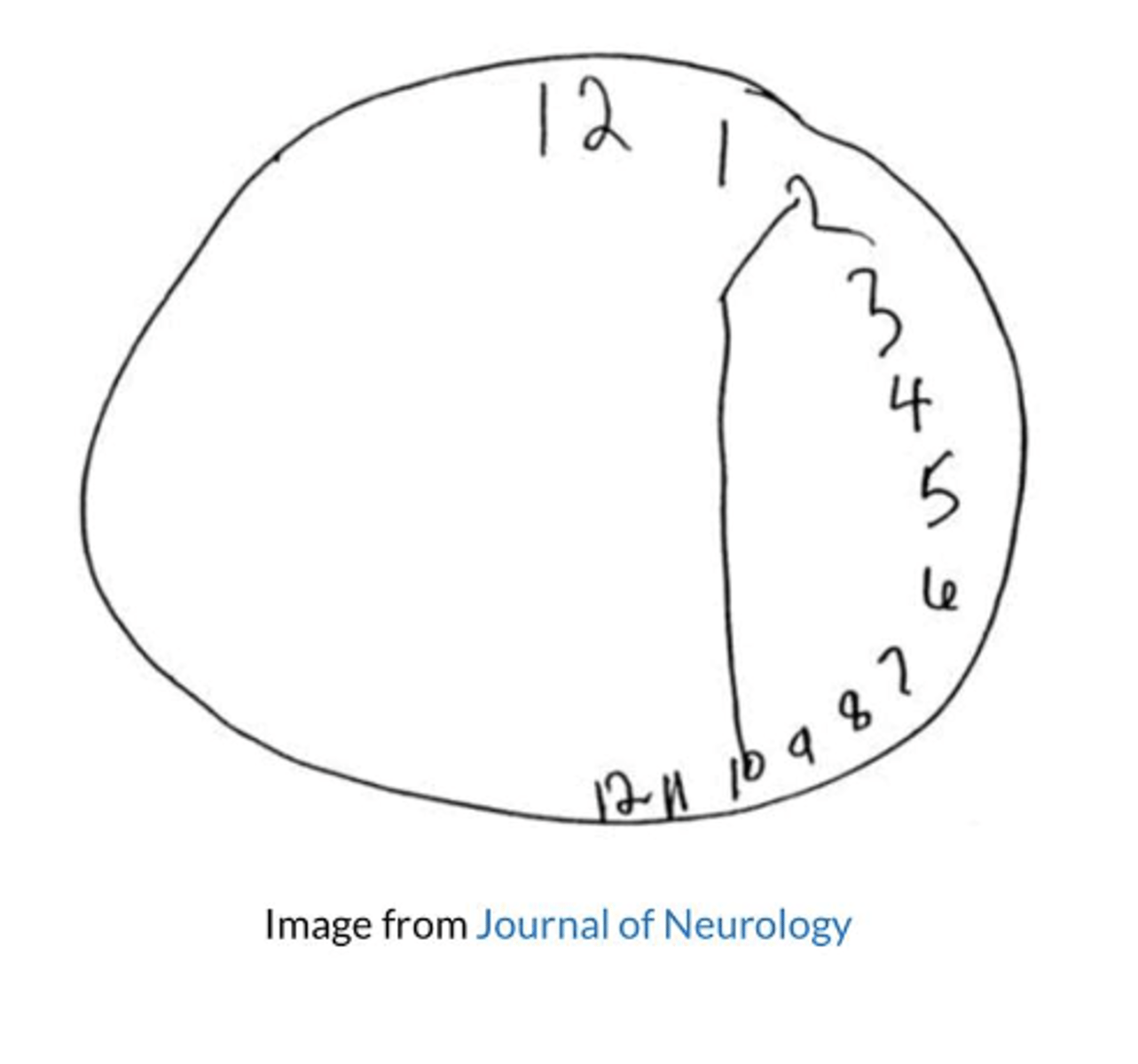 <p>- Quickly assesses visuospatial and praxis abilities, and may determine the presence of both attention and executive dysfunctions</p><p>- Versions: verbal command; copy command; time setting instructions</p><p>- Scoring: no standardized system available but looking for errors</p><p>- Need paper and pencil</p>