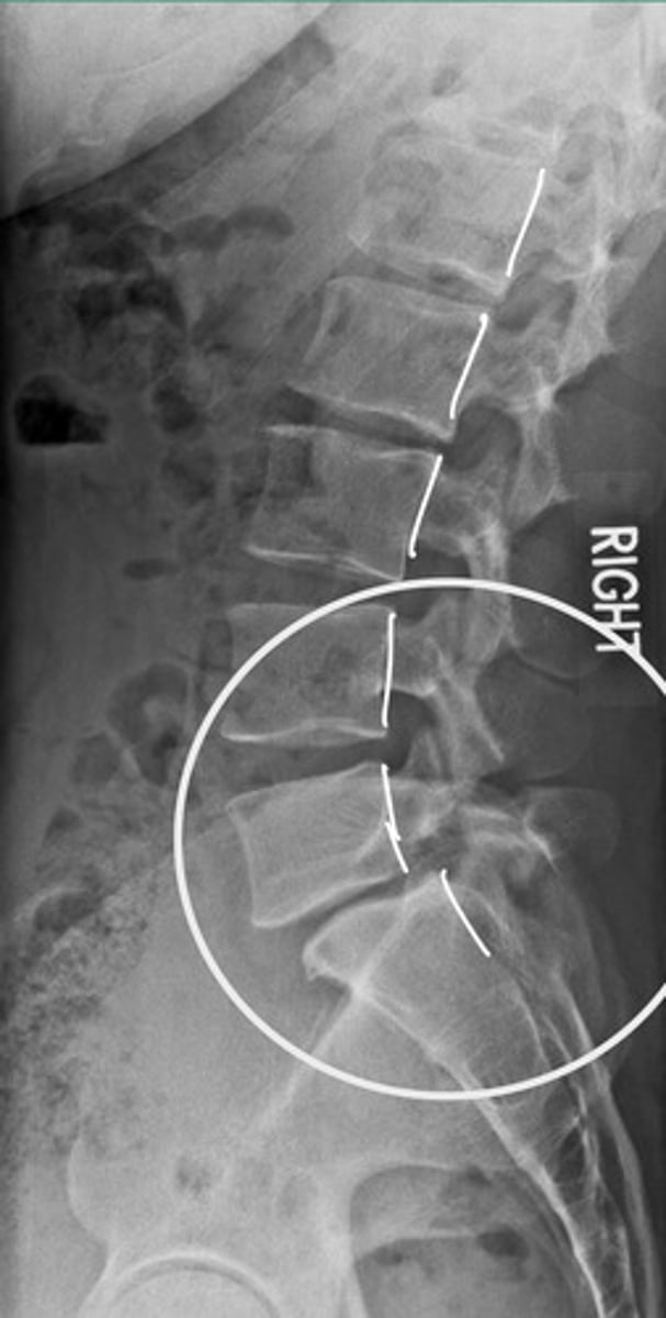 <p>What type of spondy is this?</p>