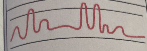 <ul><li><p><strong>Irregular</strong> pattern characterized by <strong>varying depth</strong> and <strong>rate of respirations</strong> followed by periods of <strong>apnea</strong></p></li><li><p>May be seen with</p><ul><li><p>Meningitis</p></li><li><p>Severe brain damage</p></li></ul></li></ul><p></p>
