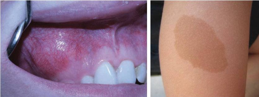 <ol><li><p>cutaneous hyperpigmentation: café au lait macules</p></li><li><p>polyostotic fibrous dysplasia&nbsp;</p></li><li><p>endocrine dysfunction: hyperthyroidism, sexual precocity&nbsp;</p></li></ol><p></p>