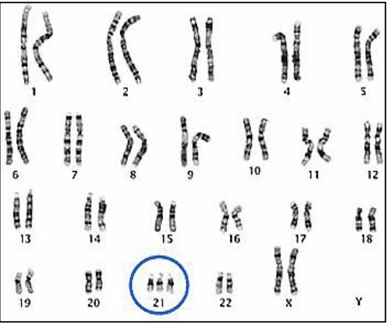 <p><u>Deducing Sex: </u></p><p>XX = Female </p><p>XY = Male</p><p><u>Deducing Chromosomal Abnormalities </u></p><ul><li><p>Errors in Meiosis can lead to the formation of zygotes with abnormal chromosome numbers (In humans, this is any number that is not 46 – 44 autosomes, 2 sex chromosomes) </p></li><li><p>Trisomy: Having a third (extra) chromosome </p></li><li><p>Monosomy: Having only one chromosome </p></li></ul>