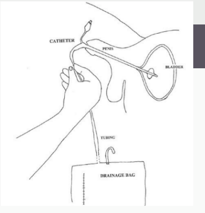 <p><strong>Male Catheter Procedure</strong></p><p>-After opening the tray and preparing the lubricant, antiseptic, and syringe, use your left hand and grasp the penis so that the _____ is in the ____ and the glans of the penis is free but secure. Should be held at a _____ angle to the abdomen. The left hand should remain in this position for the remainder of the procedure, as it is no longer sterile. </p><p>-Sterilize the ____ and urethral meatus with 3-4 swabs dipped in ________. </p><p>-Put a single loop in the Foley for easier handling, grasp the catheter in the right hand, and coat the ___ of the catheter with _________ jelly. Often helpful to place some on the meatus as well </p><p>-Insert the catheter into the urethral meatus and advance it down the penile ______ to the ____ of the penis with successive, steady movements. Advance the catheter through the _________ and prostatic urethra into the bladder.</p><p>-Advance the catheter to the ____ to ensure that the balloon is not inflated into the urethra. Release the penis </p><p>-Inflate the balloon with the proper amount of ______ water for its size and ________ the catheter until the balloon is pulled snugly against the ______</p><p>-Connect the urinary drainage system bag and tape the catheter to the upper thigh.</p><p>-If the patient is uncircumcised, remember to ______ the foreskin back. </p>