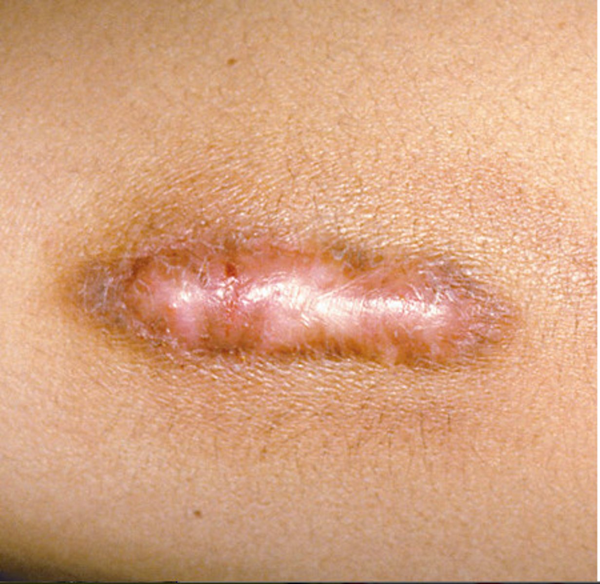 <p>Overgrowth of fibrous tissue during scare formation --&gt; leads to keloid formation</p>