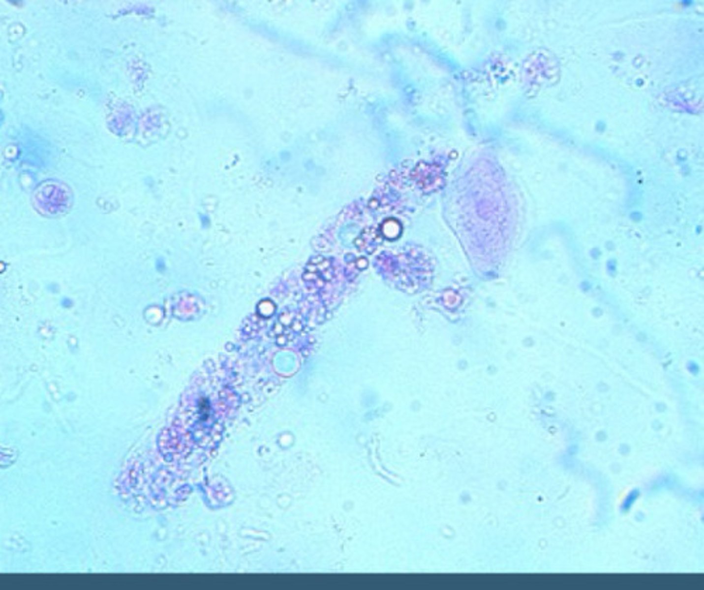 <p>Hyaline casts which contain lipid droplets and can be overserved in patients with Liguria</p><p>Associated with nephrotic syndromes</p>
