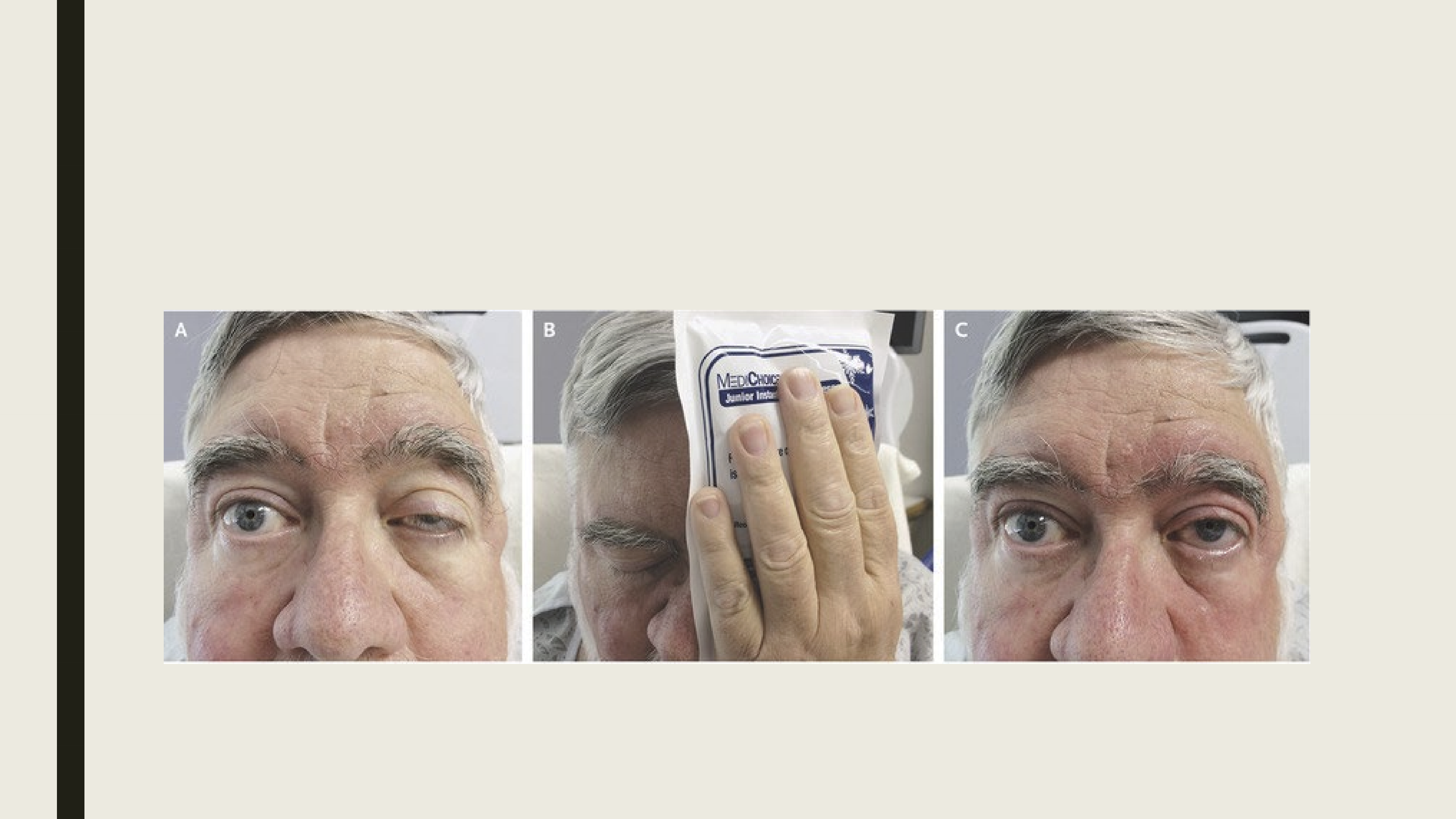 <ul><li><p>Sustained up gaze: should see a worsening ptosis from looking up for 5 minutes</p></li><li><p>With the Ice Pack Test ptosis should improve/reduce </p></li></ul><p></p>