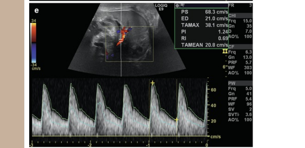 <p>normal <strong><u>splenic artery</u></strong> flow is</p><p>.</p><p>a) laminar </p><p>b) has Reynold’s number >2,000</p><p>c) high resistant</p><p>d) hepatopetal </p>