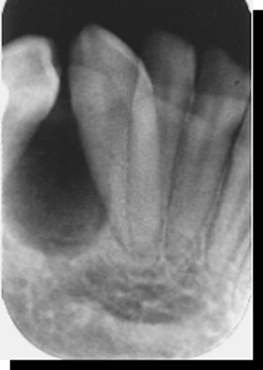 <p>what is the normal shape of benign tumors?</p>