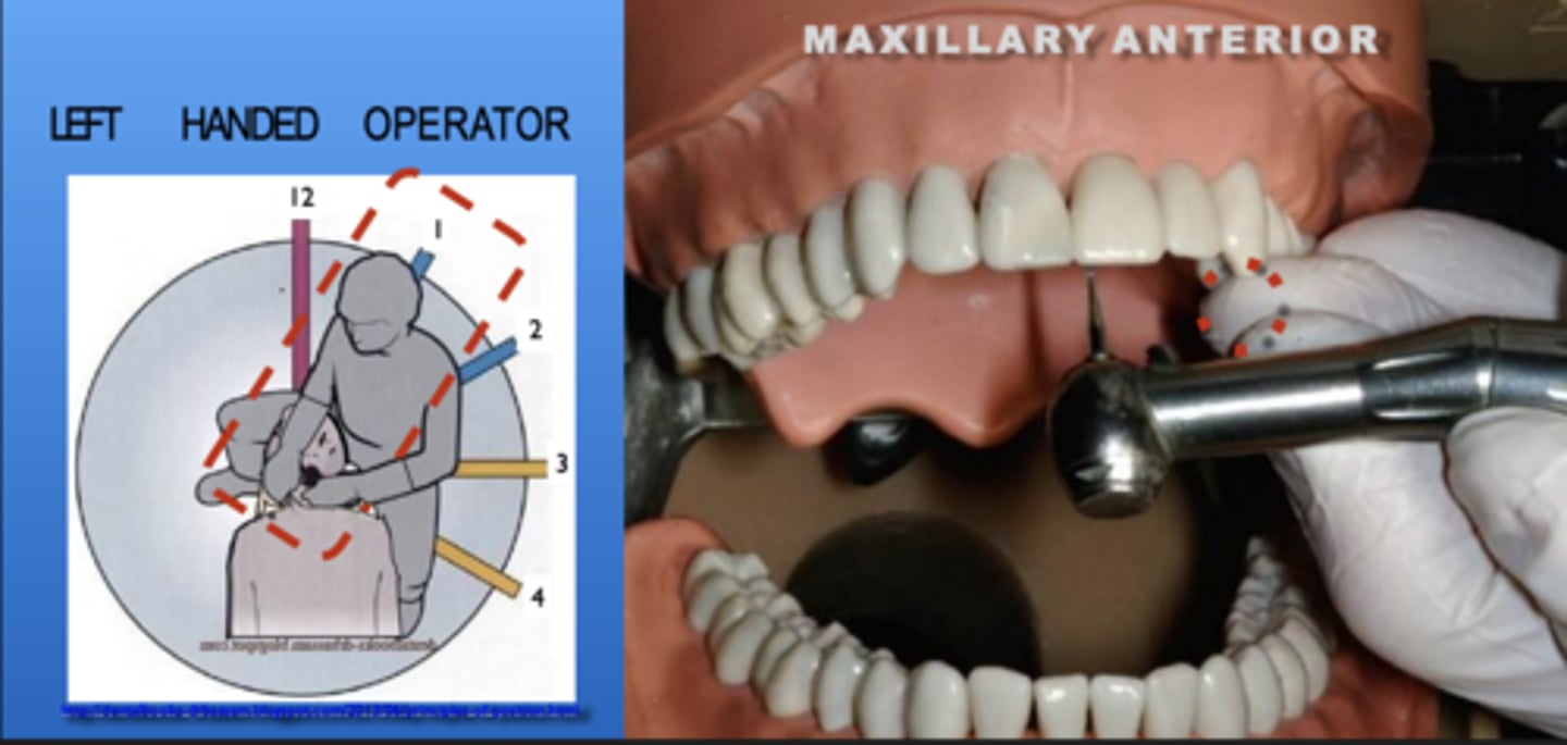 <p>Zone: 1</p><p>Vision: Direct or Indirect</p><p>Patient's Head: Center</p><p>Fulcrum: Max Left Premolars (O)</p>