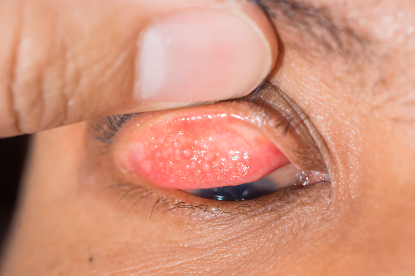 <ul><li><p>Discrete raised <strong>translucent lesions</strong> with <strong>blood vessels running around them</strong></p></li><li><p>Indicate<strong> prolonged inflammation has been present</strong></p></li></ul><p></p>