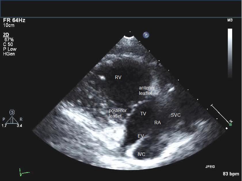 <p>How is the Right Ventricular Inflow Tract (RVIT) view obtained from the PSLA view?</p>