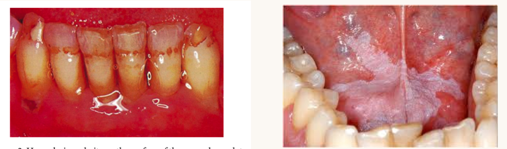 <p>what is this condition and what vitamins is this person likely deficient in?</p>