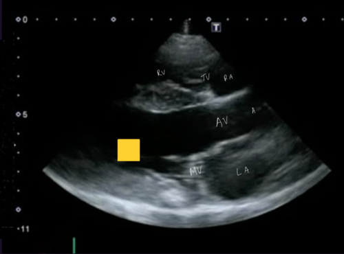 <p>Right parasternal 5 chamber view</p>