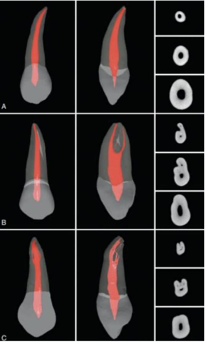 <p>ovoid (flattened M and D surfaces)</p>