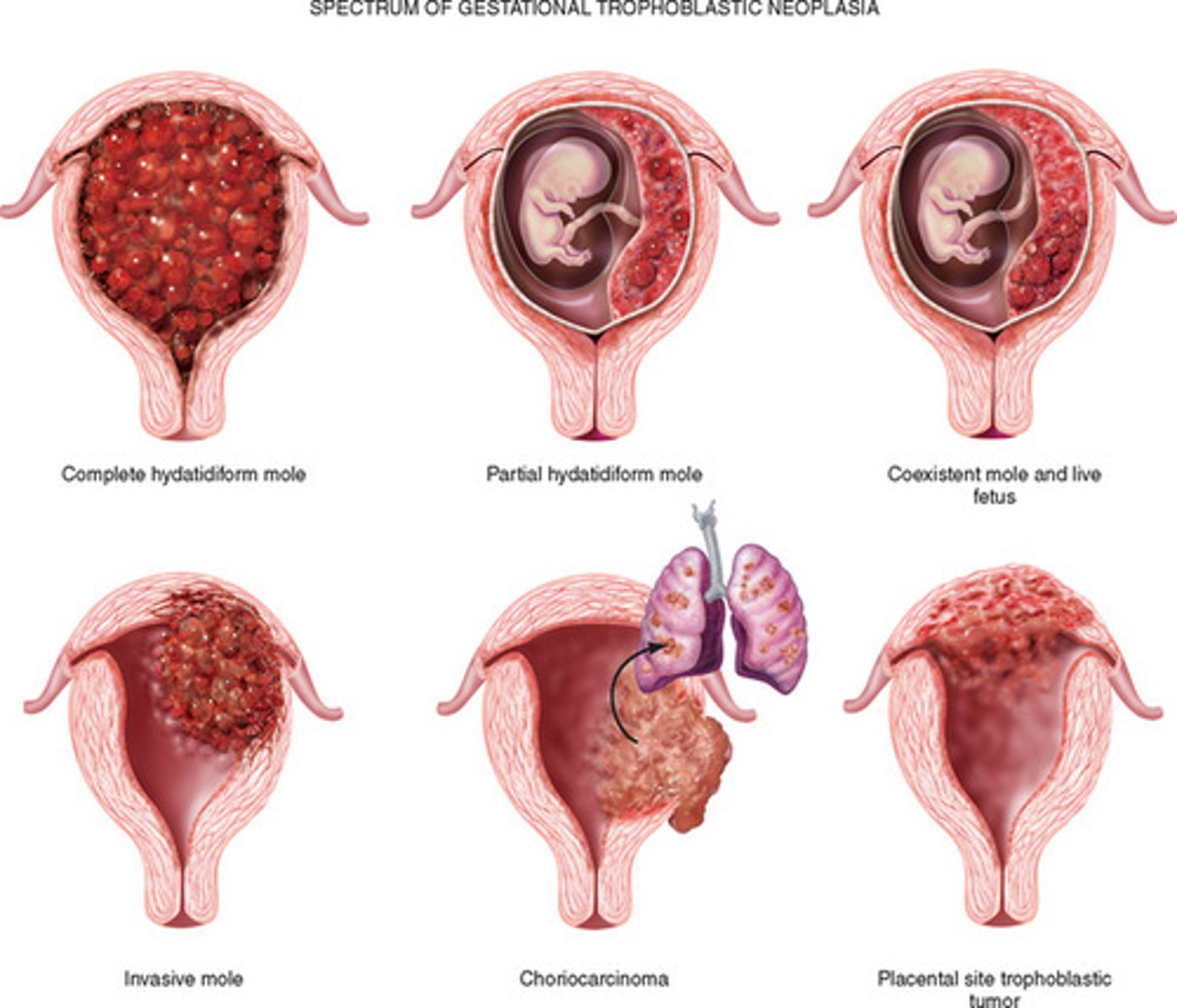 <p>Previously called "Trophoblastic tumors"</p><p>Include 3 lesions associated with pregnancy:</p><p>- Hydatidiform mole (complete or partial)</p><p>- Invasive mole </p><p>- Gestational choriocarcinoma </p>