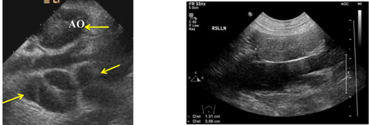 <p>which medial iliac ln. is neoplastic and which is normal/reactive?</p>