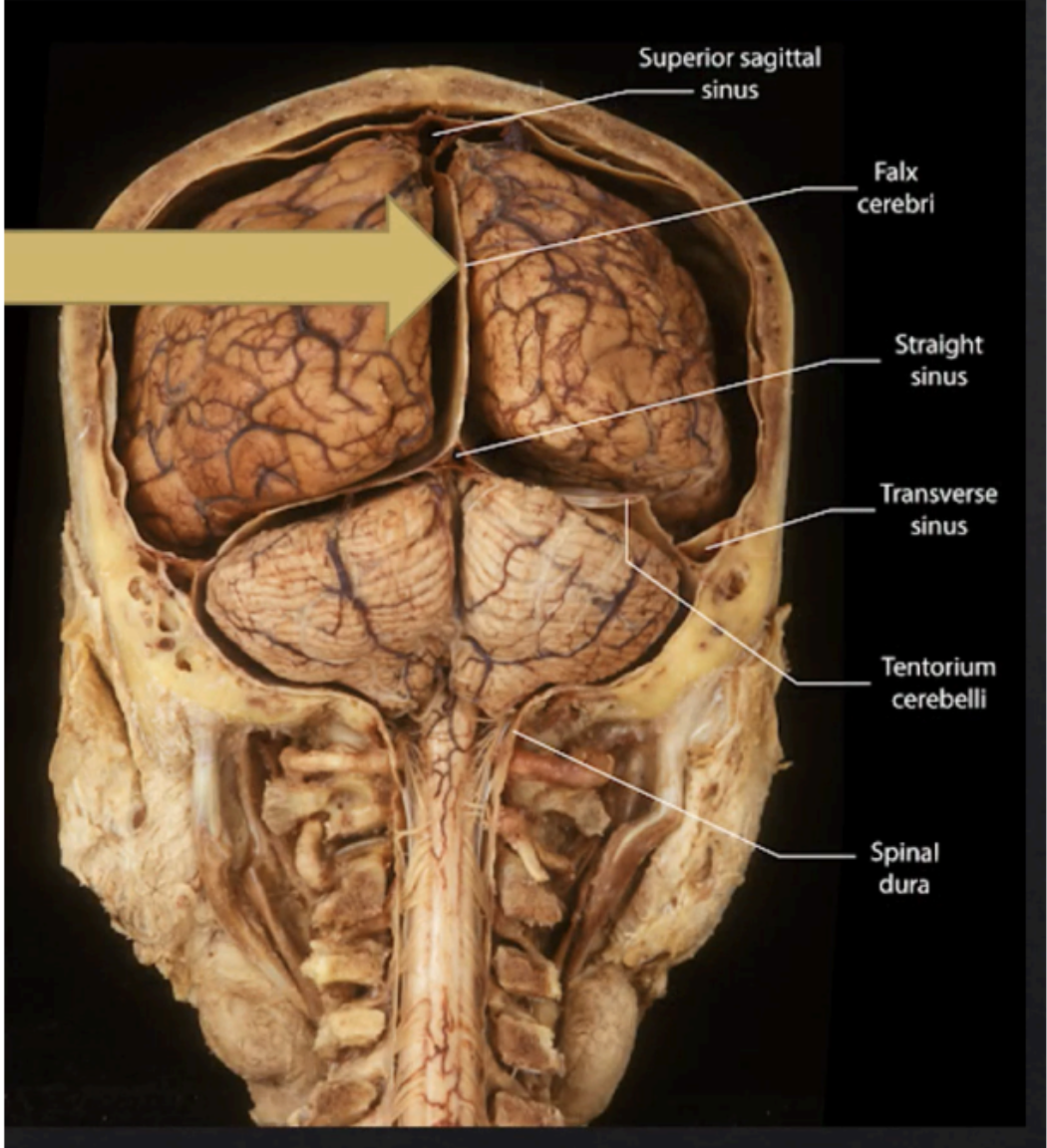 <p>Falx Cerebri</p>