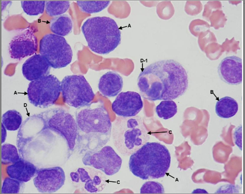 <p>Select from the choices below the best report that reflects this pleural fluid cytospin image from a patient with refractory non-hodgkin lymphoma:</p><p>Lymphoma cells, mesothelial cells, macrophages, neutrophils</p><p>lymphocytes, Lymphoma cells, macrophages, neutrophils, hemophaocytosis</p><p>mesothelial cells, macrophages, neutrophils, hemophaocytosis</p><p>neutrophils, hemophaocytosis, mesothelial cells, Lymphoma cells, macrophages,</p>