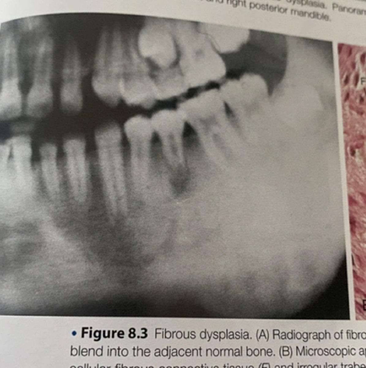 <p>-is a developmental disease that is charcterized by the replacement of bone with abnormal fibrous connective tissue</p><p>-a genetic mutation has been identified as the underlying cause of this disorder</p><p>-</p>