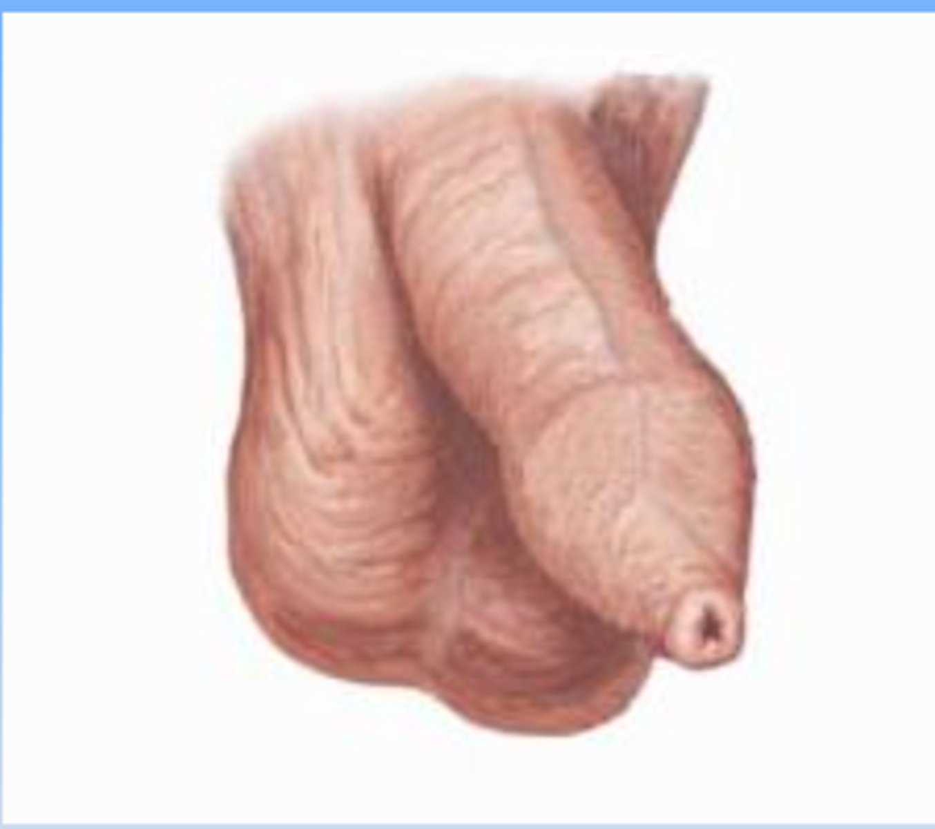 <p>narrowing of the opening of the prepuce over the glans penis</p>