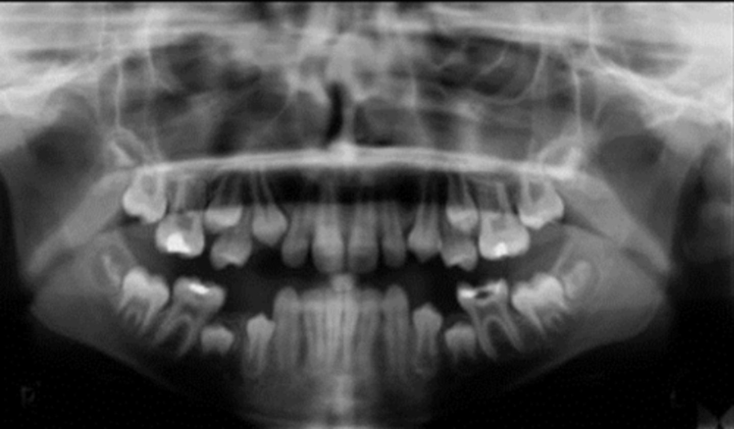 <p>what is the approximate age of this patient?</p><p>a. 6-7</p><p>b. 8-9</p><p>c. 10-11</p><p>d. 12-13</p>