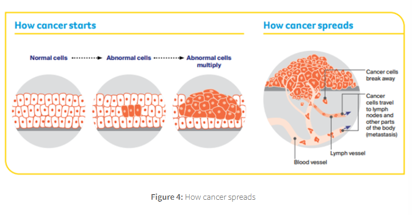 <p>this is when cancer has developed somewhere in the body then spread via the bloodstream/ lymphatic system to the liver</p>