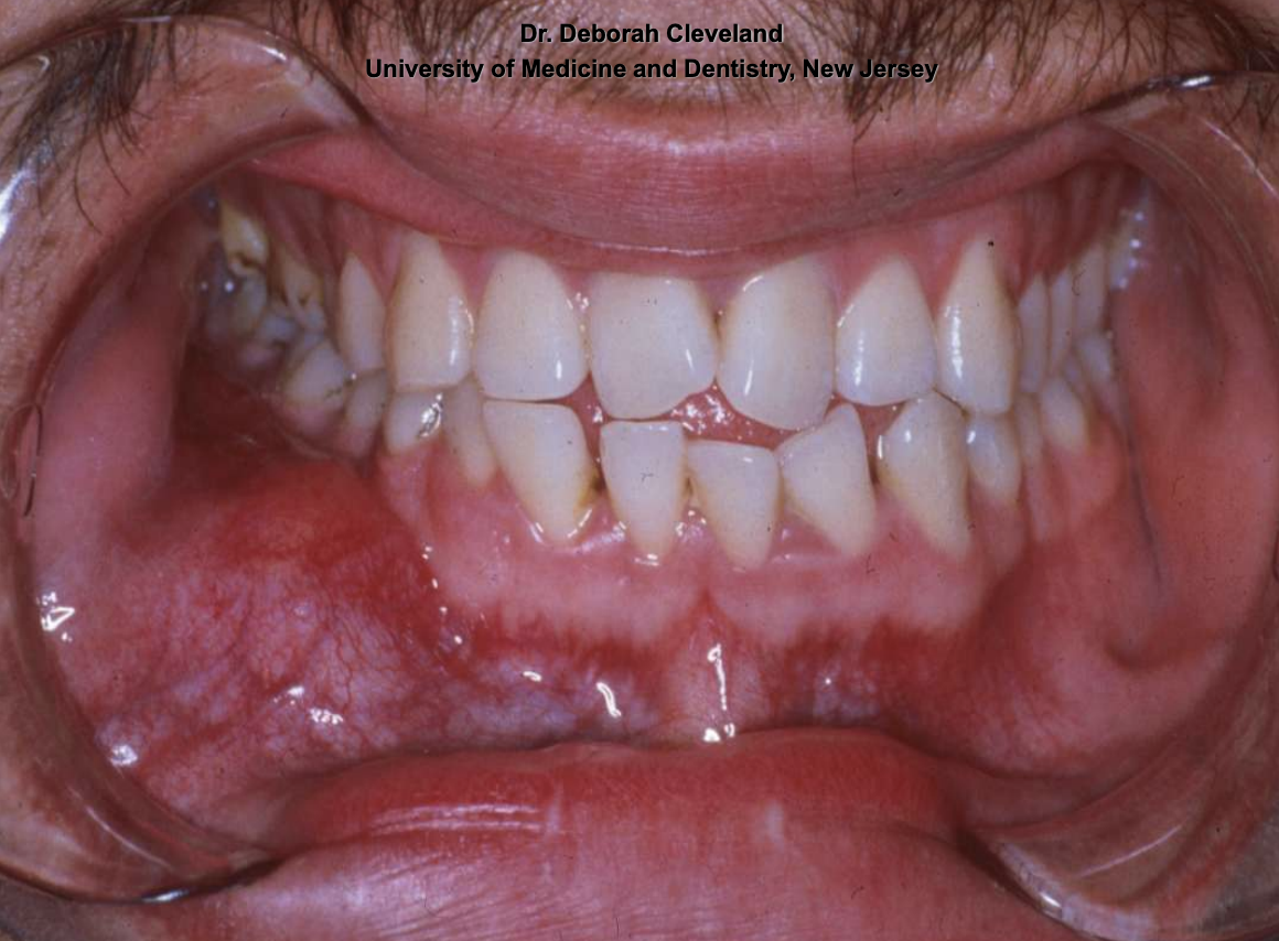 <p>• Small lesions asymptomatic</p><p>• Larger lesions associated with painless swelling</p>