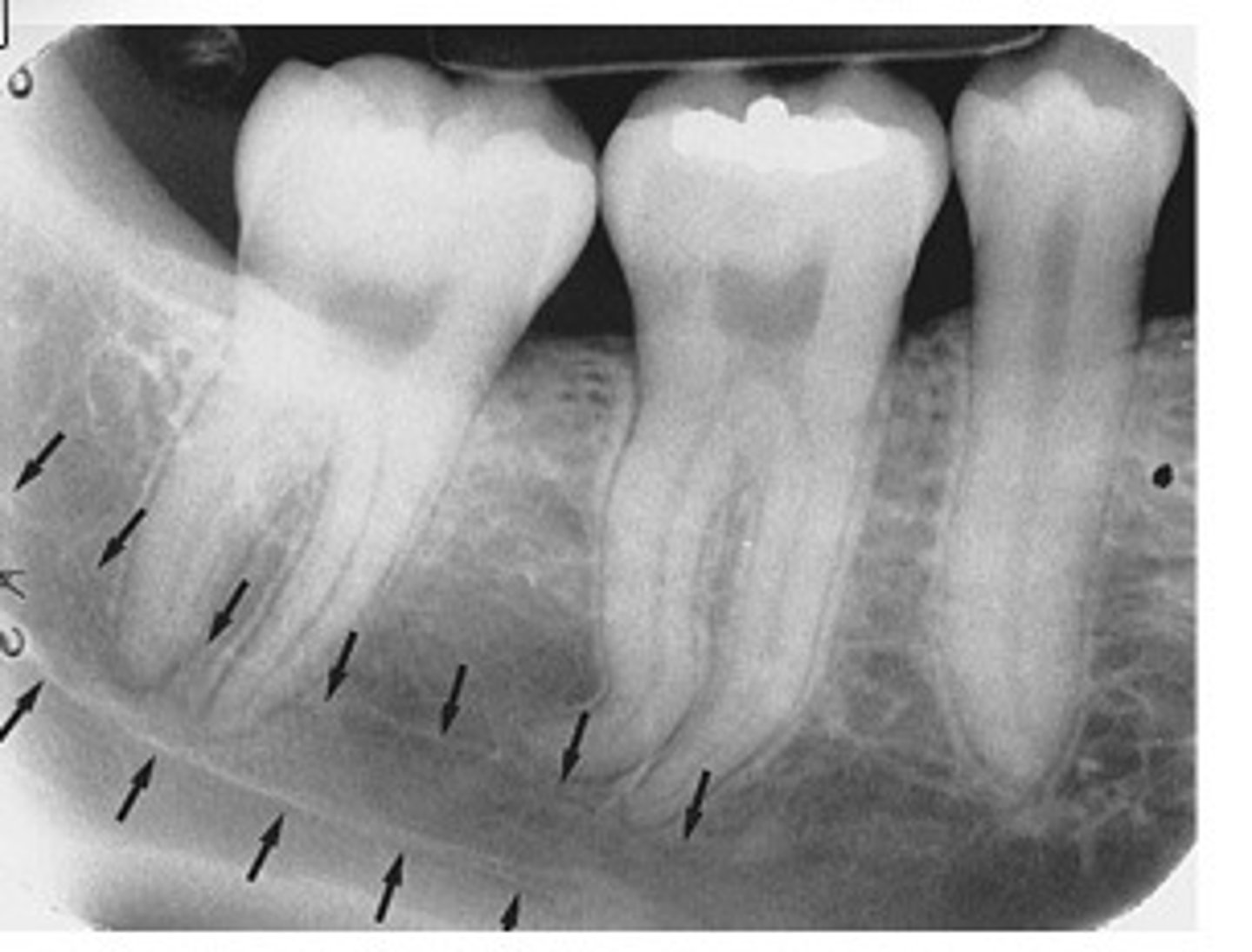<p>What is the radiolucent structure seen here?</p>