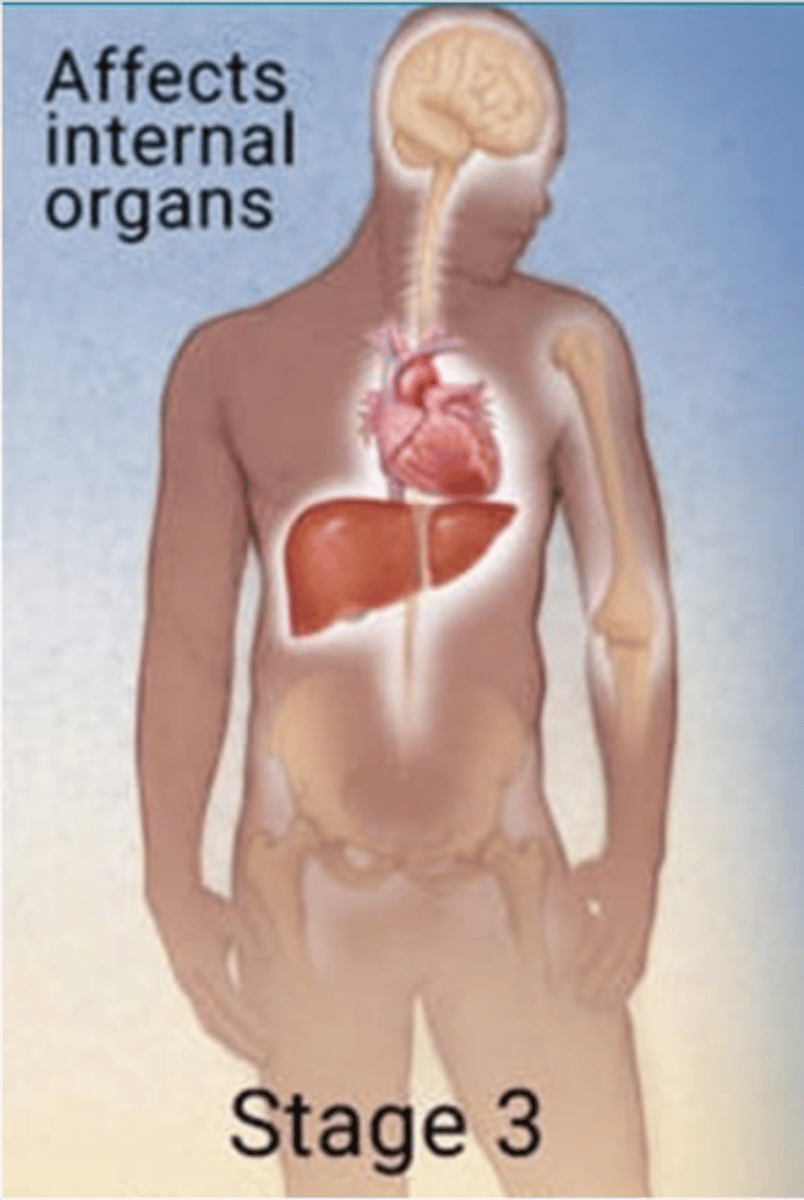 <p>Years after initial infection</p><p>Occurs in 1/3 of untreated cases</p><p>Skin, subcutaneous tissue, bone, viscera: Granulomatous lesions (of subcutaneous tissues)</p><p>Cardiovascular: Aortic insufficiency or aortic aneurysm</p><p>Psychiatric: Memory loss/dementia, personality changes</p><p>Neurologic: Numbness, paresthesias, paralysis, seizures</p><p>EENT: Eye pain, vision changes, blindness, pupillary changes, hearing loss; Argyll-Robertson pupil</p>