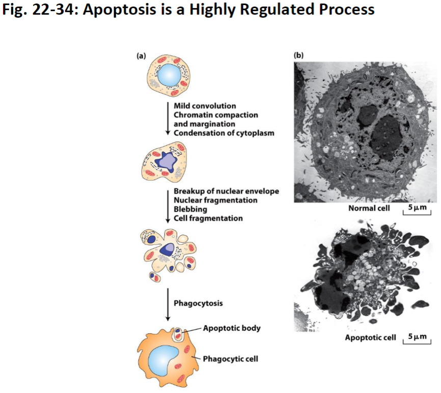<p><strong>Mild Convolution</strong><br> Cell begins to change shape slightly</p><p><strong>Chromatin Compaction and Margination</strong><br> Chromatin (DNA + proteins) condenses and moves toward the edges of the nucleus</p><p><strong>Cytoplasm Condensation</strong><br> Cytoplasm becomes denser as cell shrinks</p><p><strong>Nuclear Envelope Breakdown</strong><br> Nuclear membrane fragments to allow controlled dismantling</p><p><strong>Blebbing</strong><br> Cell surface forms bubble-like protrusions</p><p><strong>Phagocytosis</strong><br> Apoptotic bodies are recognized and eaten by phagocytic cells for recycling</p>