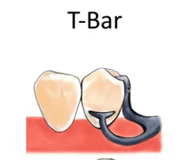 <ul><li><p>T and Y </p></li><li><p>It is not necessary to have the full area of T or Y terminal for adequate clasp retention. </p></li><li><p>Only portion of clasp engaging the undercut area </p></li><li><p>Large area of contact provides greater frictional resistance, does not guarantee true clasp retention</p></li></ul><p></p>