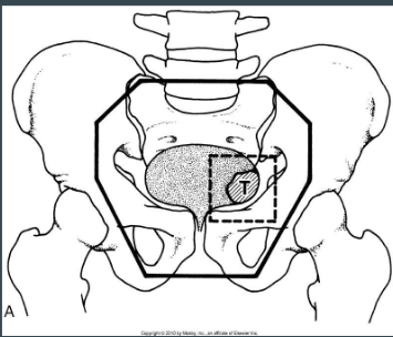 <p>bottom of obturator foraman or 2 cm below tumor</p><ul><li><p>men: coverage of prostate</p></li><li><p>women: proximal 2 cm or urethra</p></li></ul><p></p>