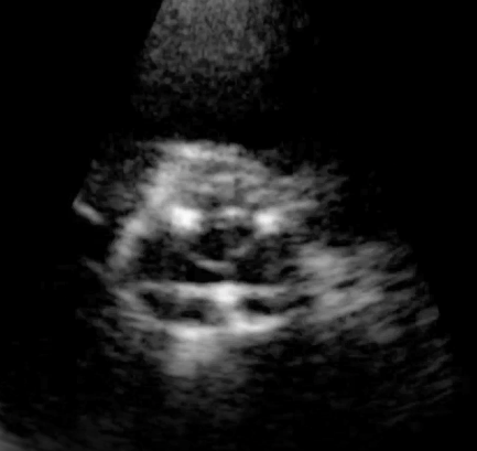<p>What valve replacement is demonstrated? </p>