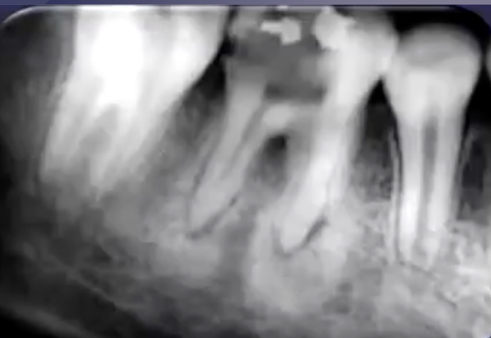 <p>bone deposition around area of rarefaction</p>