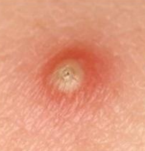 <p>vesicle, pustule, or bulla</p>