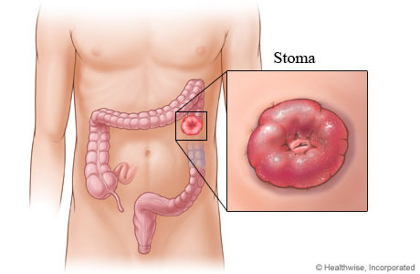 <p>creation of an artificial opening into the colon</p><p>* stool is more formed (colon)</p><p>* more formed stool</p>