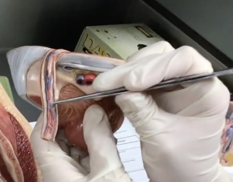 <p>Description: Tube-like structure of the spermatic cord extending from the epididymis to the ejaculatory duct</p><p>Relationship: Common site for vasectomies</p>