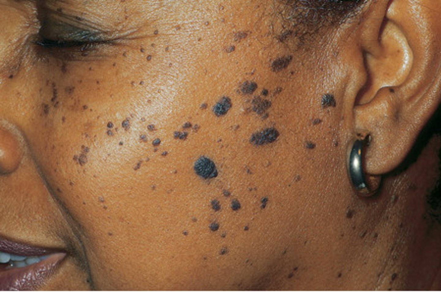 <p>abnormally thick buildup of cells</p>
