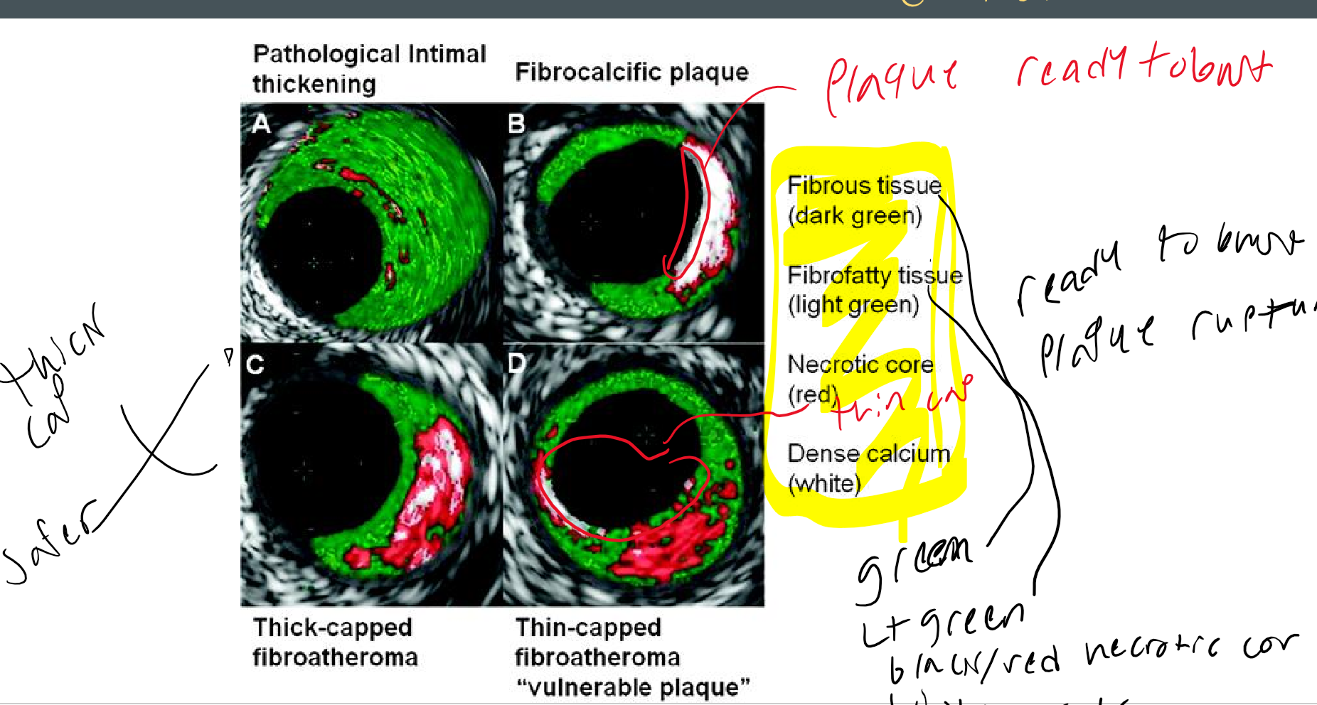 <p>necrotic core</p>