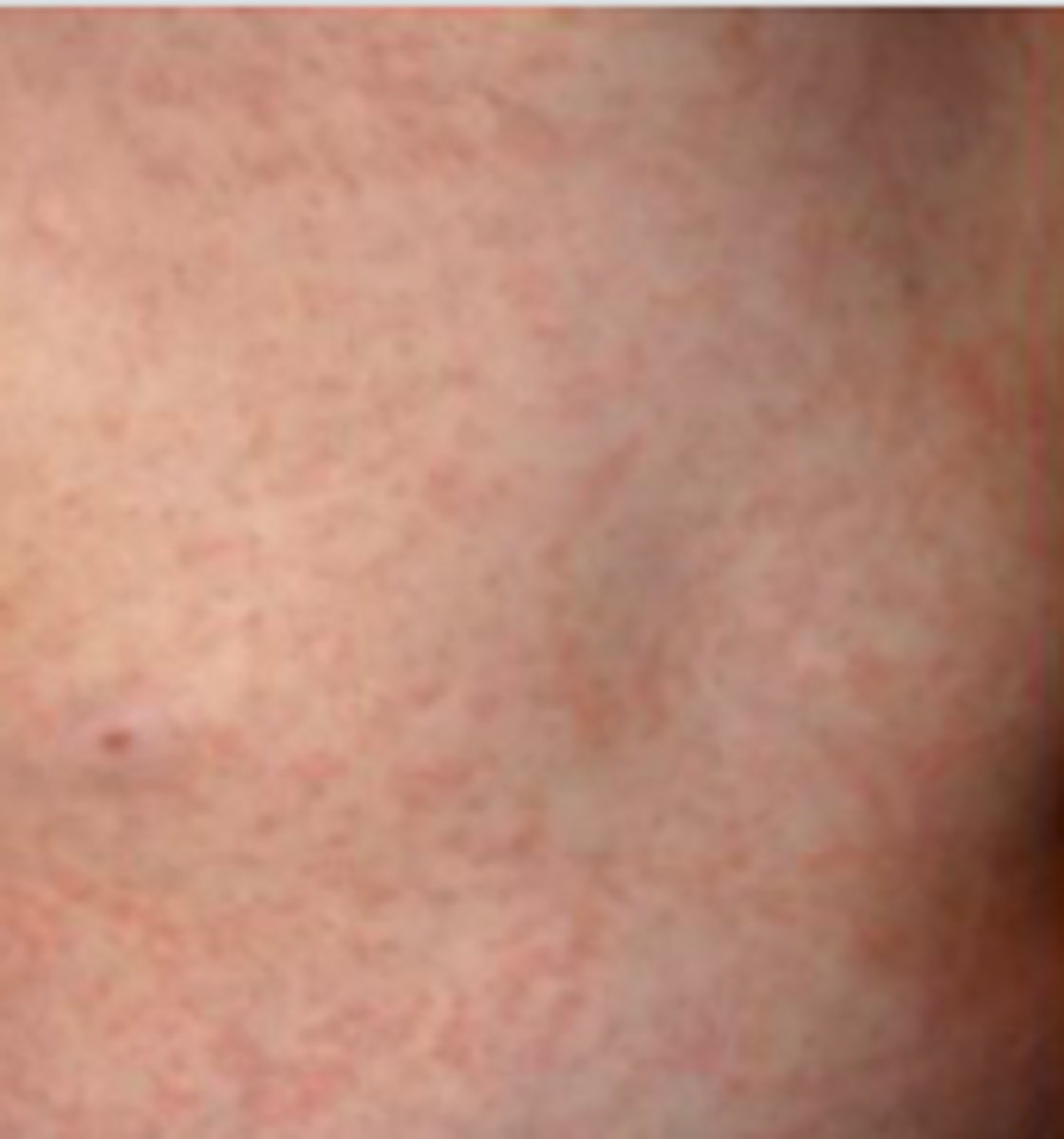 <p>Exanthems:</p><p>Overview:</p><p>- Caused by bB variant of human herpesvirus 6 (HHV-6)</p><p>90% in children &lt;2 years</p><p>- Peak incidence is in spring and seasons</p><p>- No known exposure and most occurs sporadically</p>