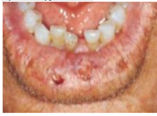 <p><span style="background-color: transparent; font-family: "Times New Roman", serif;">*<strong>Oral lesions in 5-25% </strong></span></p><p><span style="background-color: transparent; font-family: "Times New Roman", serif;"><strong>  - palate, buccal mucosa, gingiva</strong></span></p><p><span style="background-color: transparent; font-family: "Times New Roman", serif;">  - variable appearance – lichenoid areas, nonspecific ulcer, granulomatous lesion</span></p><p><span style="background-color: transparent; font-family: "Times New Roman", serif;">*<strong>Lupus Cheilitis: vermillion of lower lip</strong> with varying degrees of ulceration, pain, erythema, hyperkeratosis</span></p>