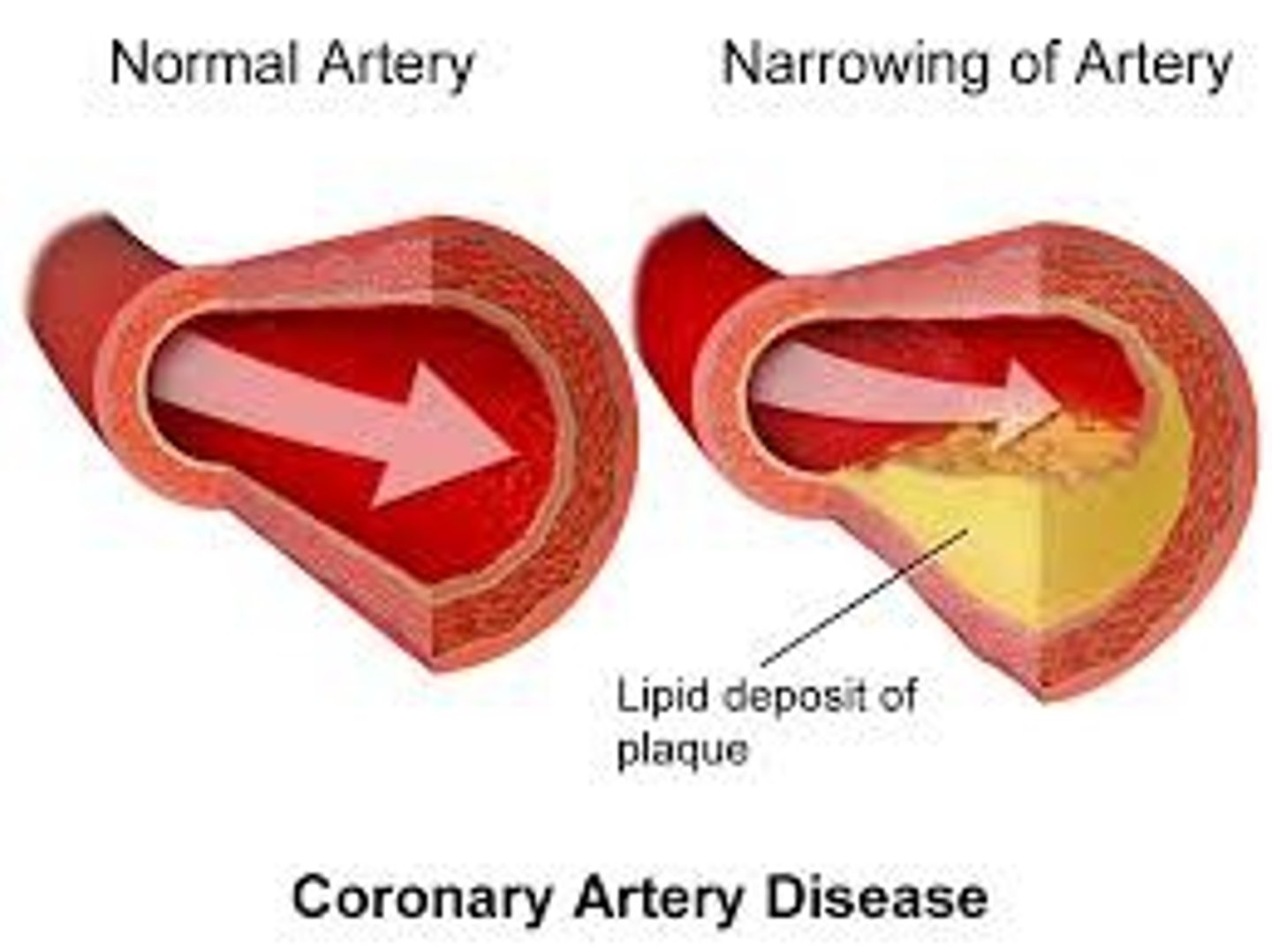 <p>A narrowing of the small blood vessels that supply blood and oxygen to the heart</p>