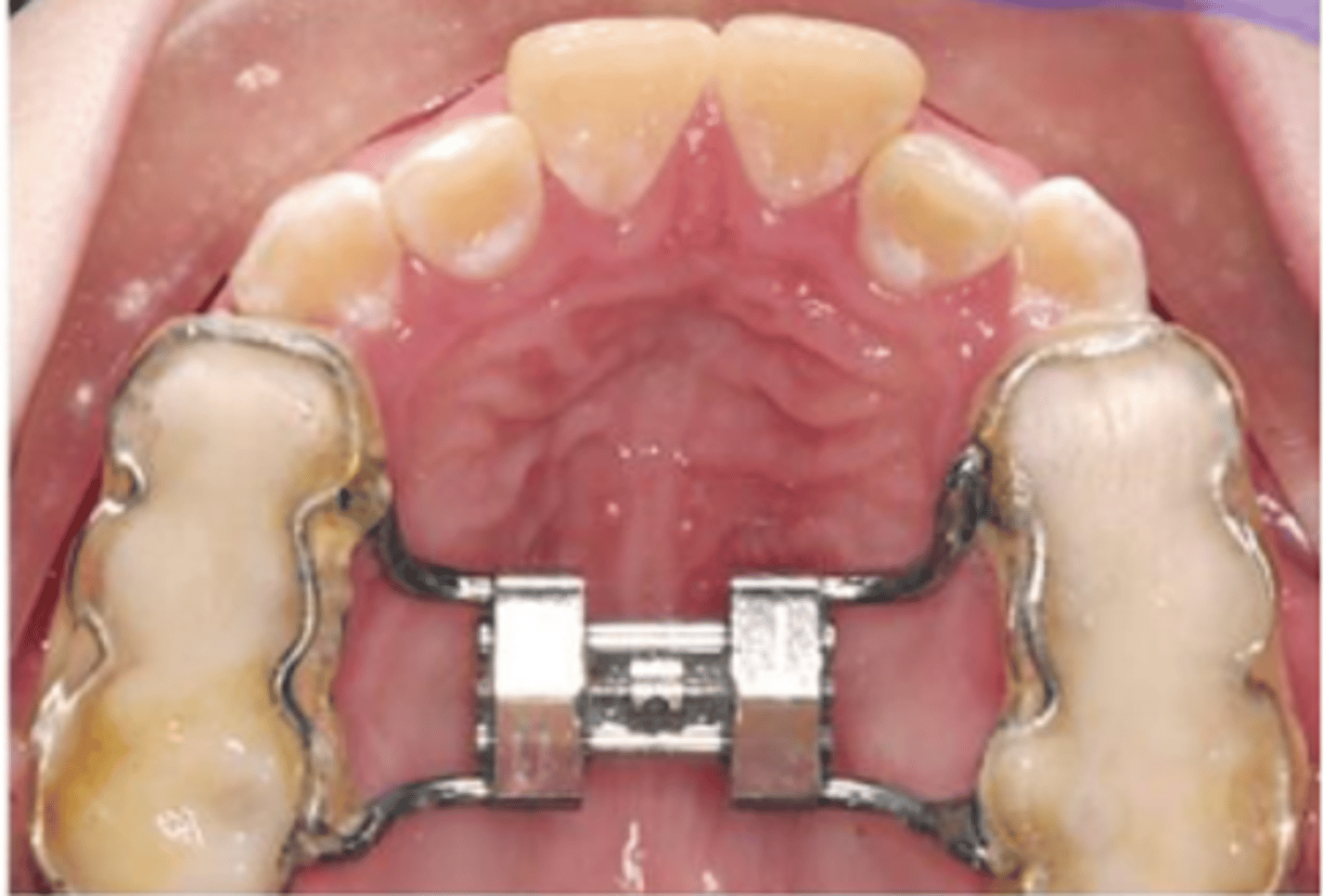 <p>device used in orthodontics to widen the upper jaw</p>