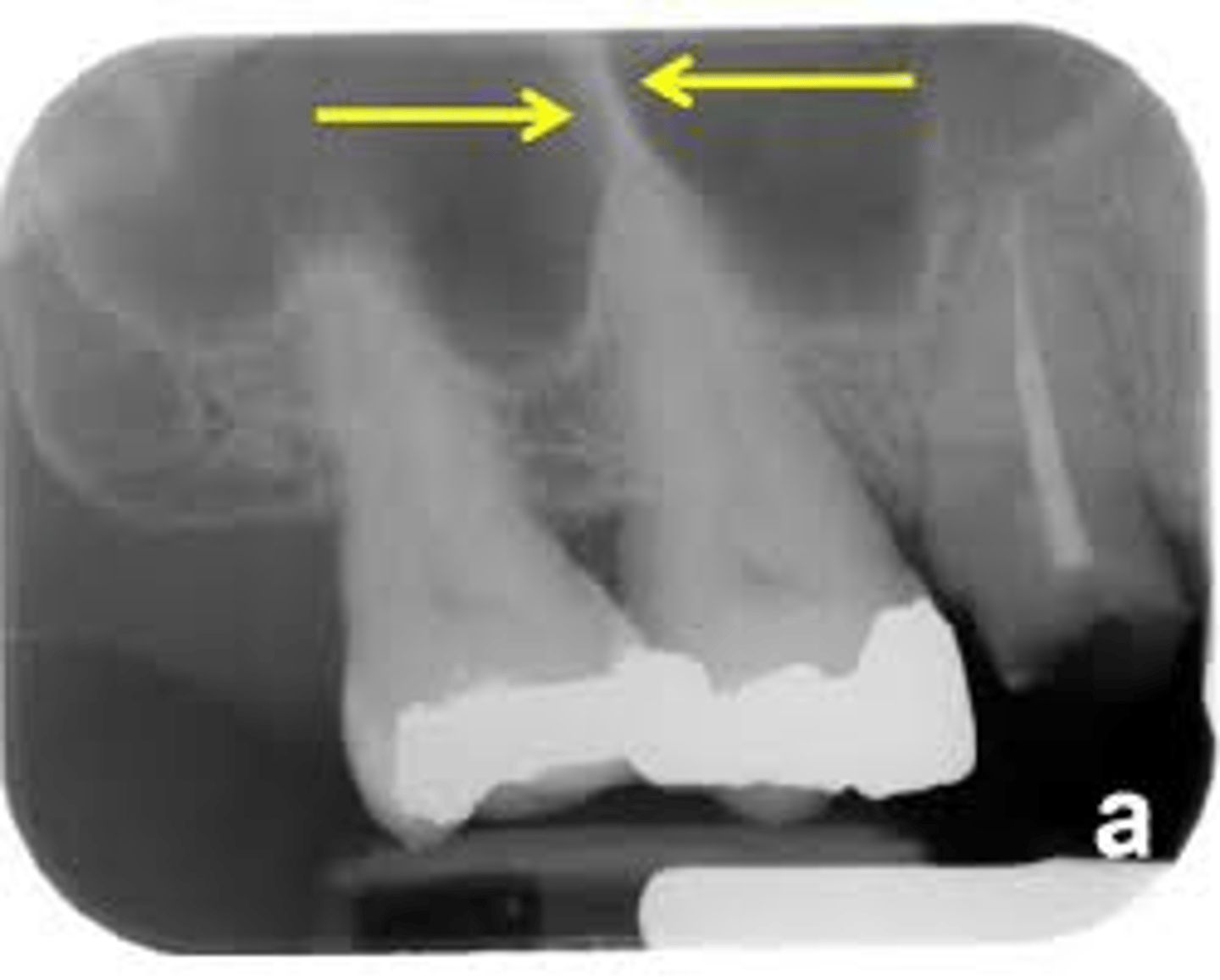 <p>thin bone separating the sinuses</p><p>radiopaque</p>