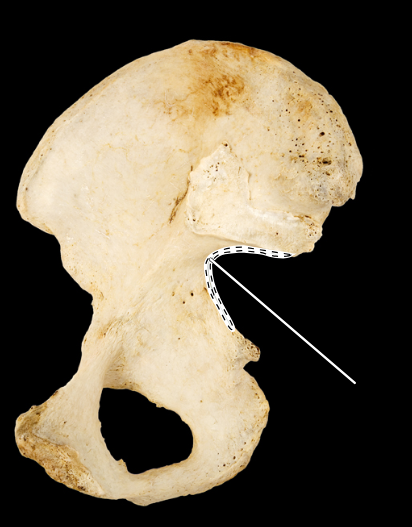 <p>Hip bone, medial view, right ilium</p>