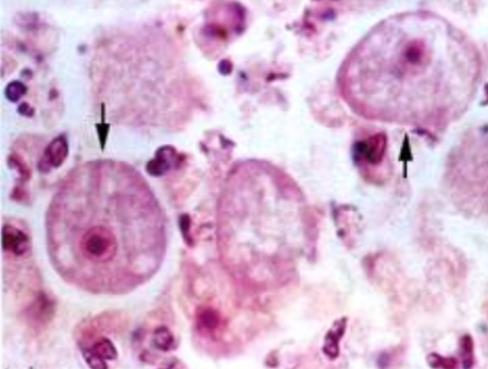 <p>MOT: diving & swimming (water enters nose)</p><p>Infective stage: bi-flagellate trophozoite</p><p>Hosts: human</p><p>Parts to look for: a large karyosome that takes up the whole nucleus</p>